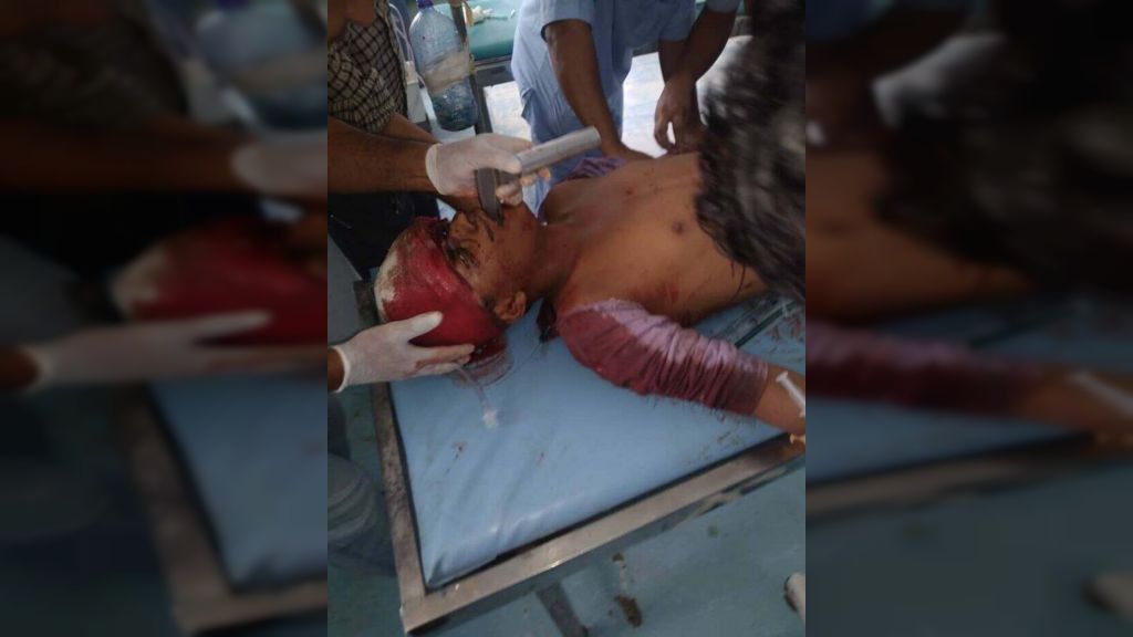 إصابة مواطن بقصف مليشيا الحوثي تجمعات سكانية جنوب الحديدة