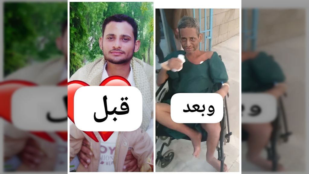 الضالع... وفاة أسير بعد أيام من إطلاق سراحه من سجون مليشيا الحوثي