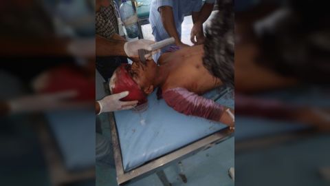 إصابة مواطن بقصف مليشيا الحوثي تجمعات سكانية جنوب الحديدة