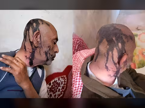 عمران... مُسن يتعرض لاعتداء وحشي على يد أبنائه المنخرطين في صفوف الحوثيين