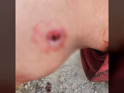 تعز... إصابة امرأة برصاص قناص حوثي في جبل حبشي